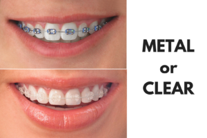 Comparison of metal and clear braces showing alignment options for orthodontic treatment.
