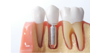 Dental implant cross-section showing titanium post anchored in jawbone with ceramic crown restoration.