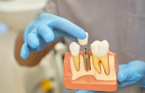 Dentist holding dental implant model showing tooth replacement between two natural teeth.