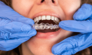 Dentist fitting clear aligner trays on patient's teeth during Invisalign treatment in Melissa, TX.