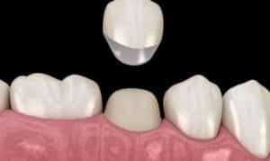 3D illustration of a dental crown placement showing a single tooth crown above the gum line with adjacent teeth.