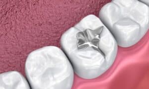 3D illustration of a tooth with a silver dental filling on a pink gum background.