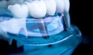 Dental implant model showing titanium screw fixture with crown restoration on anatomical jaw model.