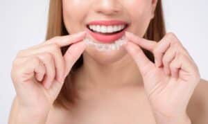 Woman inserting a clear Invisalign aligner tray into her mouth, showing proper placement technique.