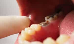 Close-up of dental anesthesia injection being administered to patient's gum during root canal treatment.