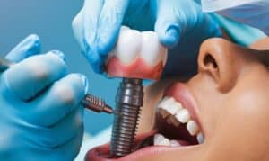Dentist holding dental implant model showing crown and titanium post during patient consultation.