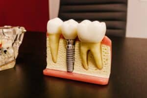 Dental implant model showing bone structure with titanium implant screw and crown restoration.