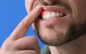 Man with gum inflammation pointing to red, swollen gum area showing gum disease symptoms.