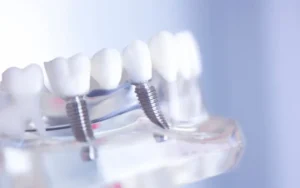 Dental implant models showing titanium posts and crown restorations on jawbone demonstration.