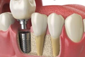 Dental implant with titanium screw and bone graft alongside natural teeth.