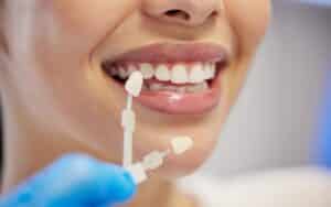 Dental veneer shade guide being matched to patient's natural teeth during cosmetic consultation.
