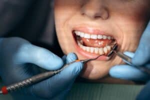 Dentist using ultrasonic scaler to clean patient's teeth during dental exam and treatment.