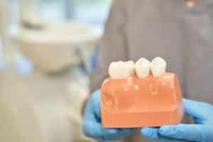 Dental crown demonstration model showing three tooth-colored crowns on orange gum model held by dentist.