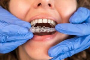 Dentist inserting clear aligner into patient's mouth for overbite correction treatment.