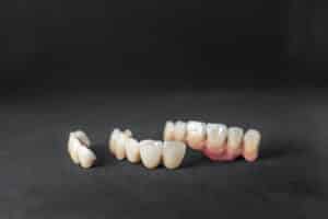 Dental crowns and bridges displayed on black surface showing tooth restoration options.