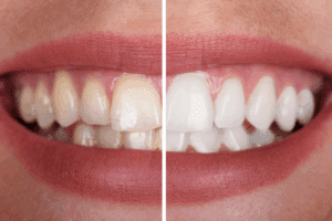 Before and after teeth whitening comparison showing yellowed teeth versus bright white teeth.