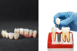 Dental implant model showing crown placement over titanium fixture between natural teeth.