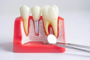 Dental implant model showing natural teeth, titanium implant post, and crown restoration with examination mirror.