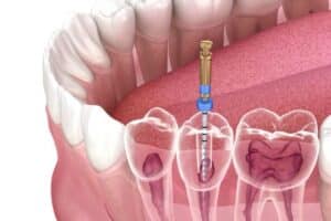 Dental implant procedure illustration showing screw placement into jawbone socket.