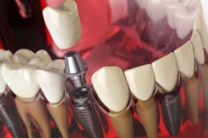 3D dental implant illustration showing crown placement on titanium posts in Melissa, TX.