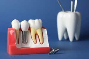 Dental implant model showing tooth replacement with screw component next to natural tooth comparison.