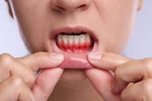 Person with inflamed red gums pointing to lower gum area showing signs of gum disease and periodontal issues.