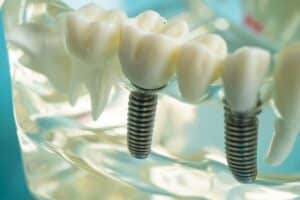 dental implant checkup frequency