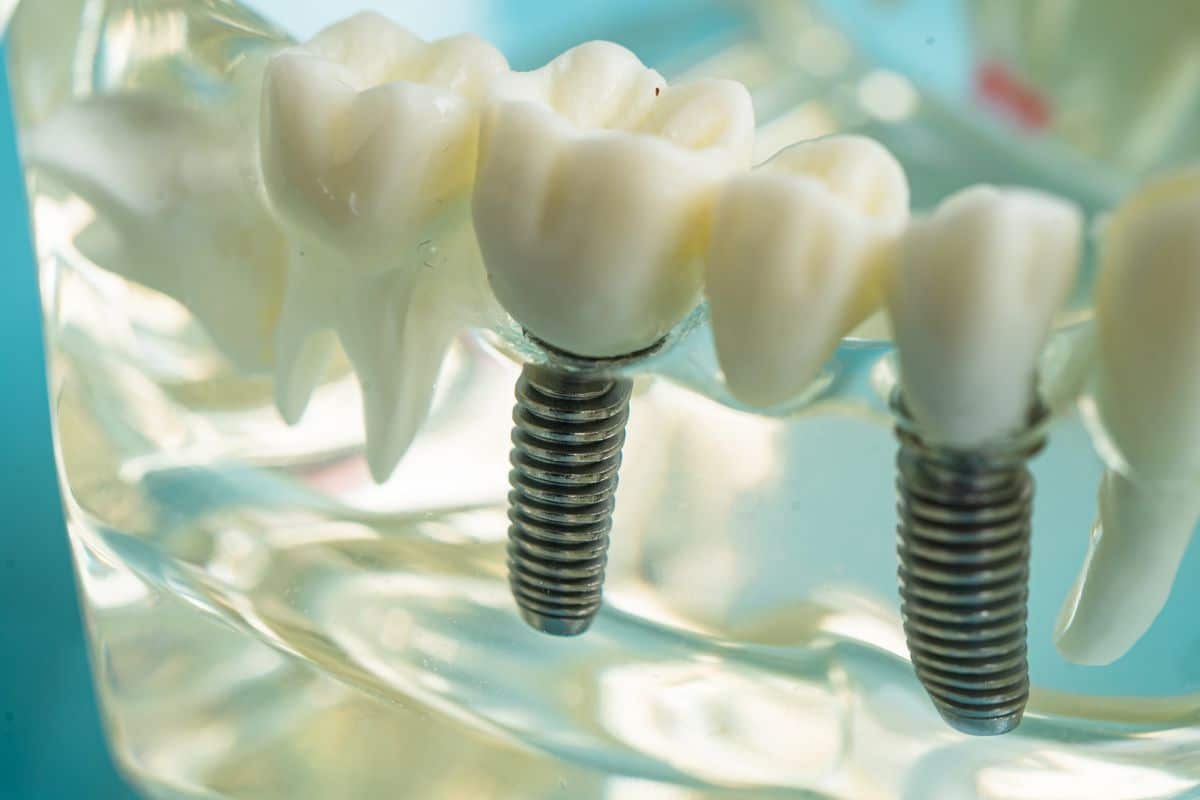 dental implant checkup frequency